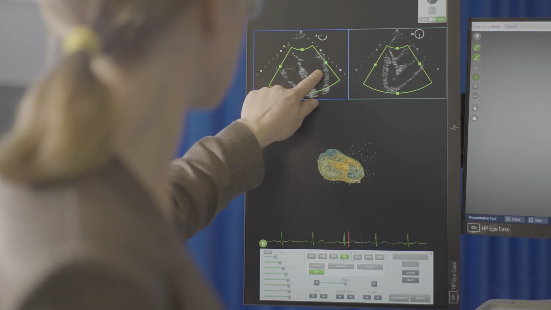 3D Echo demonstration video - Intelligent Ultrasound